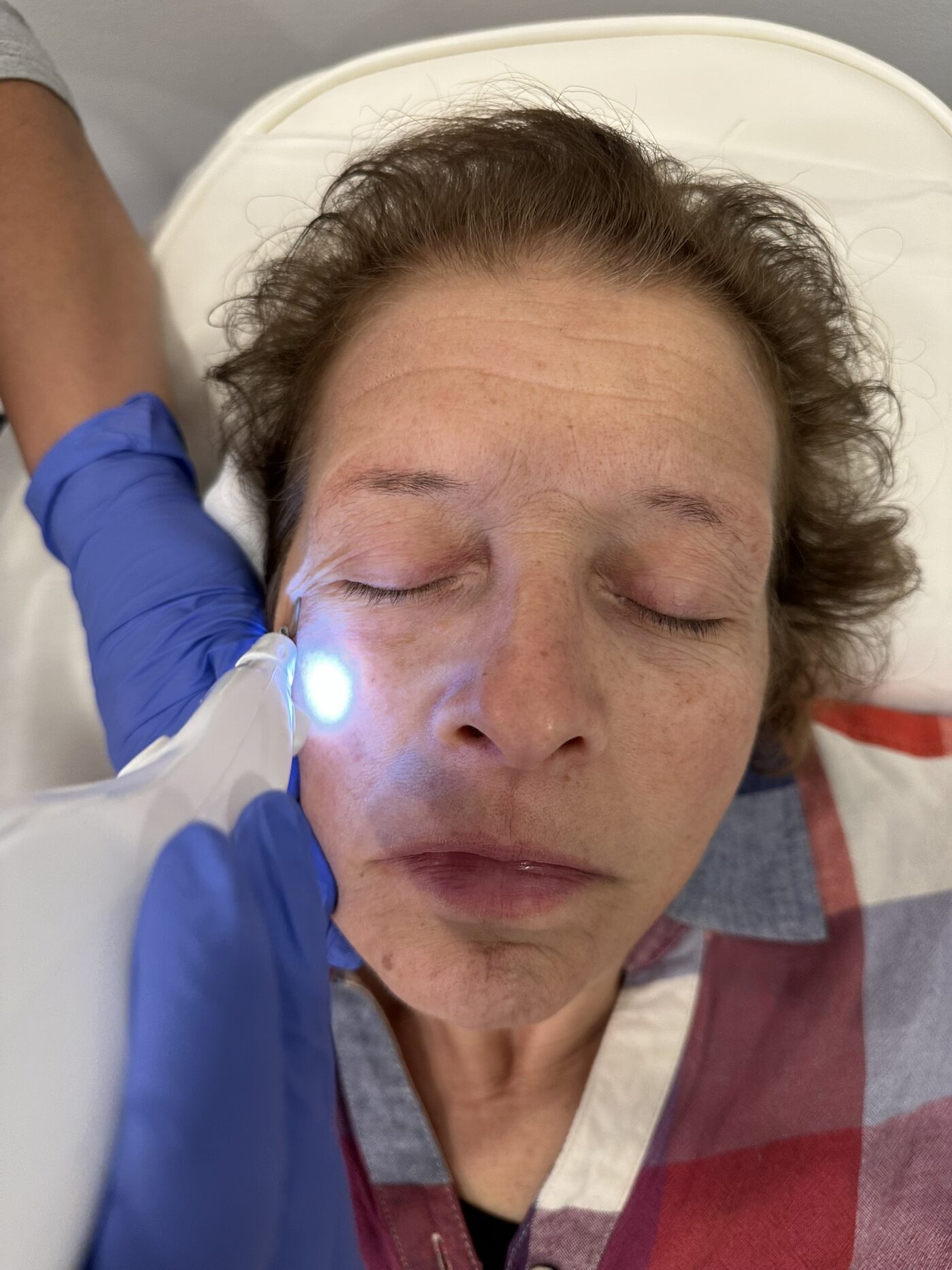 Plexr Plus plasma treatment around the eyes at Arbour Longevity